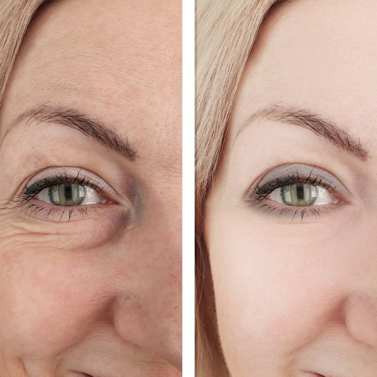 Rejuvenecer arrugas hidratación