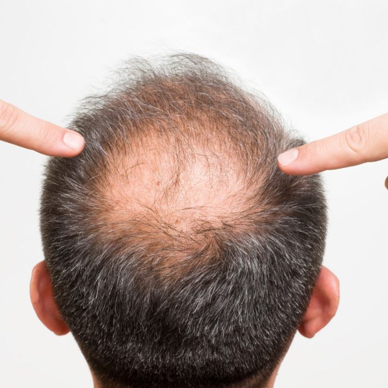 calvicia pelo caida cabello